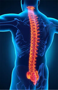 Lumbar disc herniation